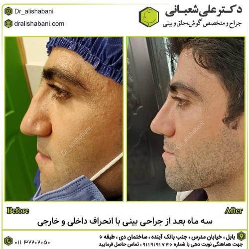 جراحی-بینی-در-بابل-140