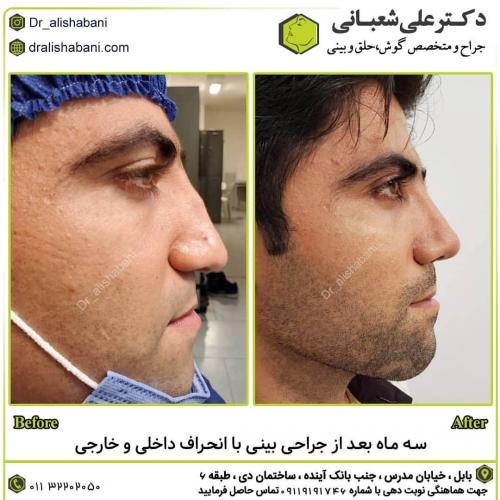 جراحی-بینی-در-بابل-141
