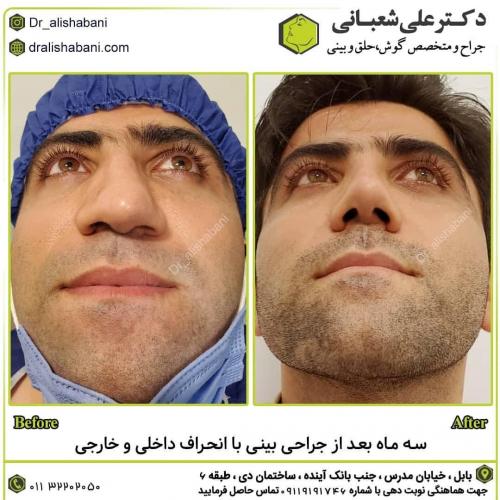 جراحی-بینی-در-بابل-142