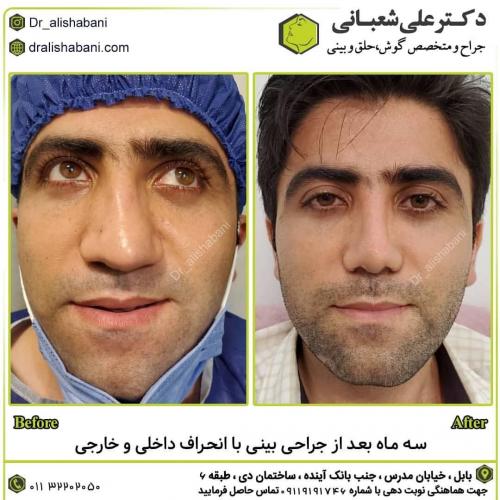 جراحی-بینی-در-بابل-143