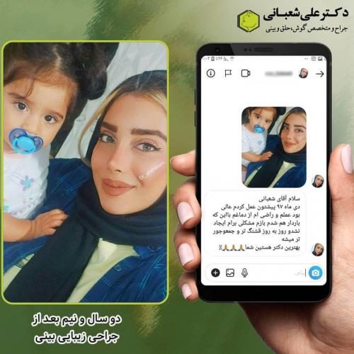 جراحی-بینی-در-بابل-144