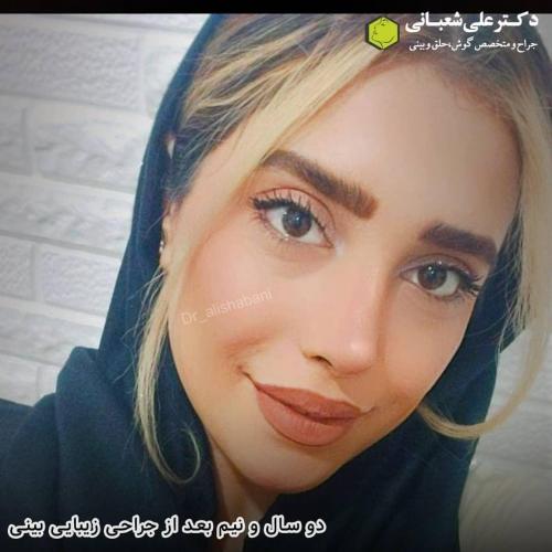 جراحی-بینی-در-بابل-145