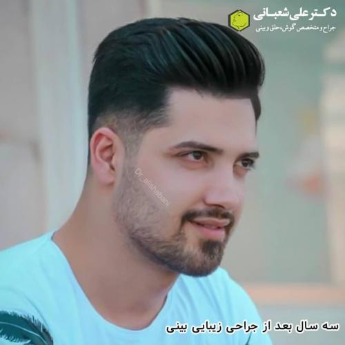جراحی-بینی-در-بابل-147