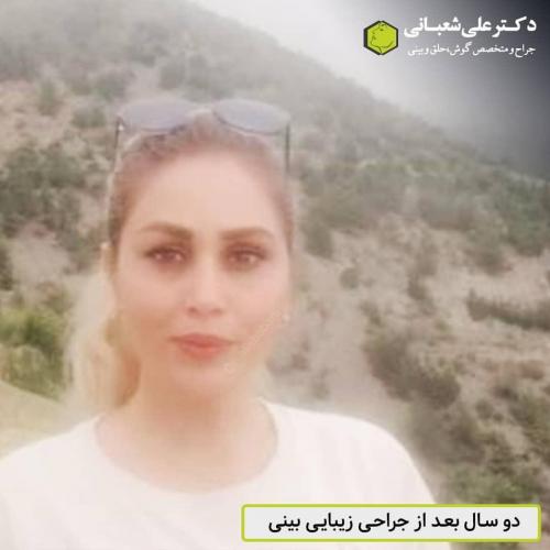 جراحی-بینی-در-بابل-150