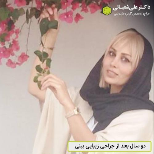 جراحی-بینی-در-بابل-151