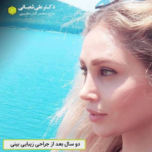 جراحی-بینی-در-بابل-152