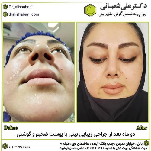 جراحی-بینی-در-بابل-153