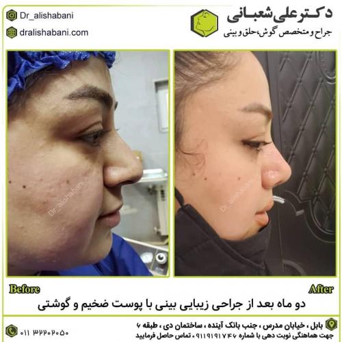 جراحی-بینی-در-بابل-154