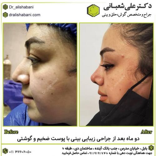 جراحی-بینی-در-بابل-155