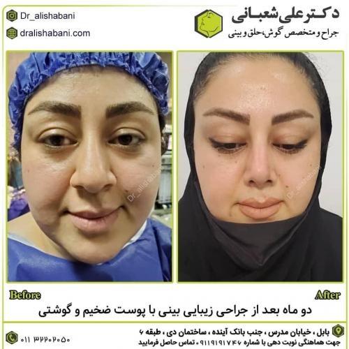 جراحی-بینی-در-بابل-156