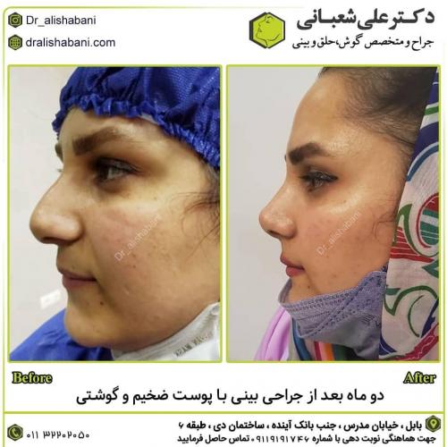 جراحی-بینی-در-بابل-157