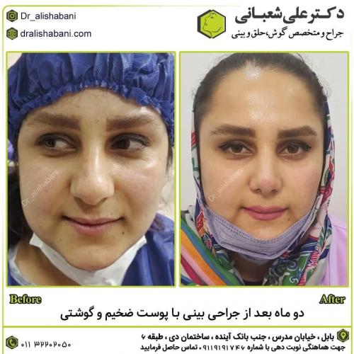 جراحی-بینی-در-بابل-158
