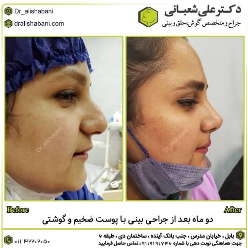جراحی-بینی-در-بابل-159