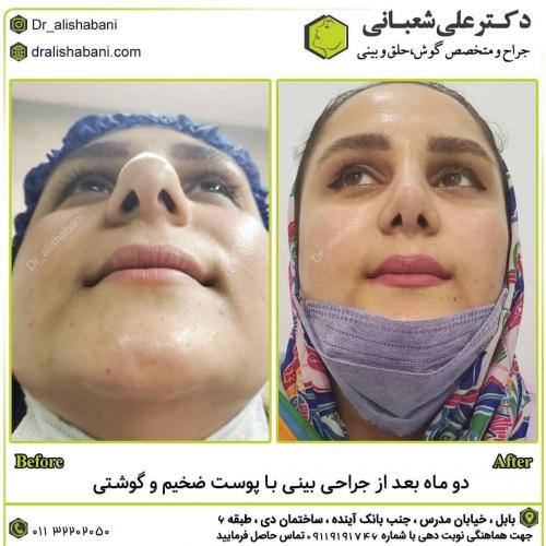 جراحی-بینی-در-بابل-160