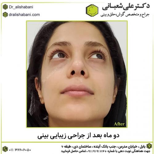 جراحی-بینی-در-بابل-161