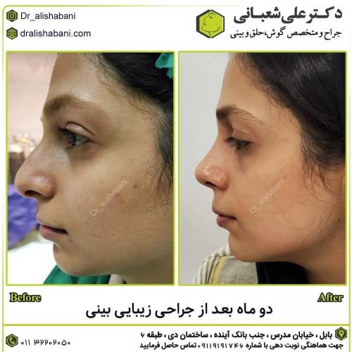 جراحی-بینی-در-بابل-162