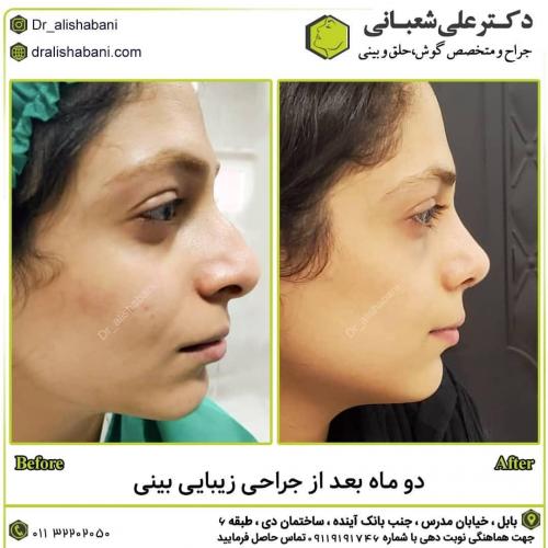 جراحی-بینی-در-بابل-163