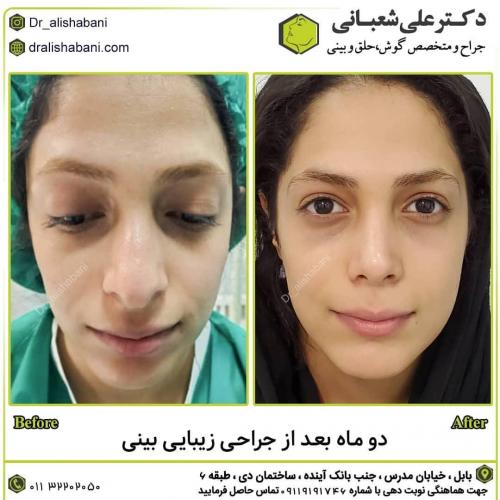 جراحی-بینی-در-بابل-164