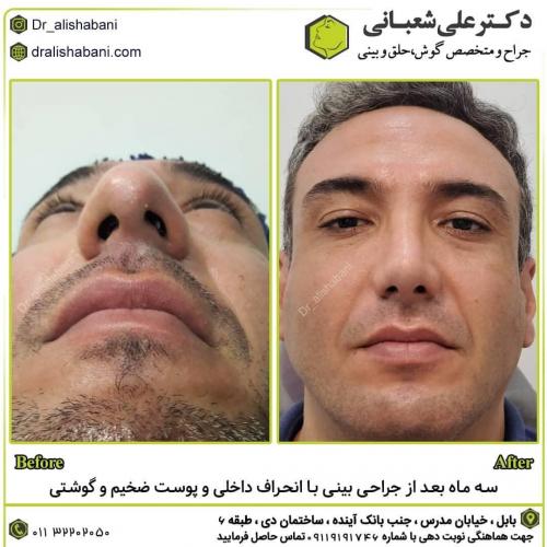 جراحی-بینی-در-بابل-166