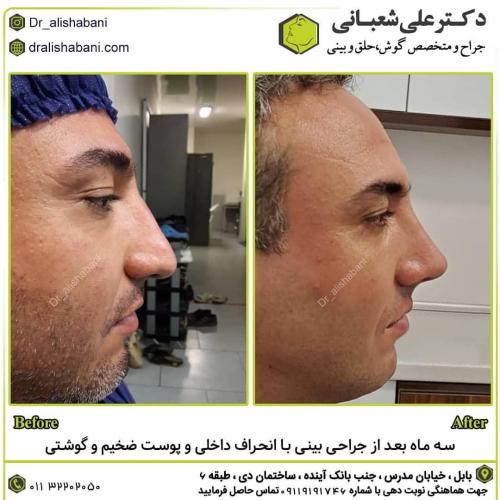 جراحی-بینی-در-بابل-167