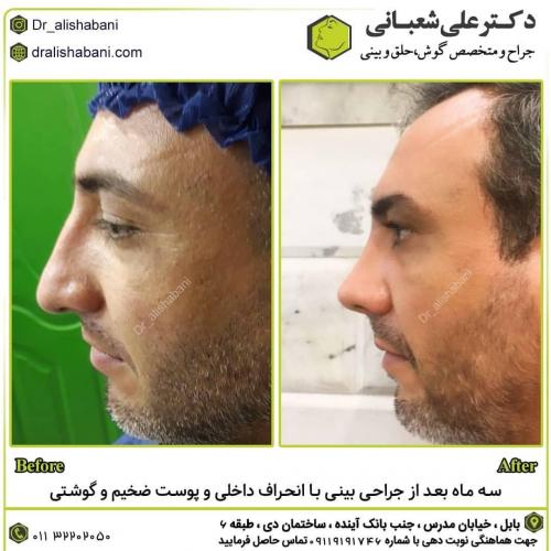 جراحی-بینی-در-بابل-168