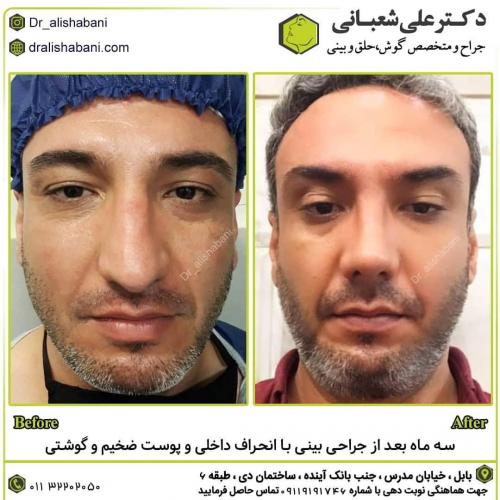 جراحی-بینی-در-بابل-169