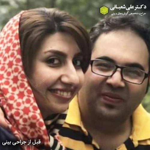 جراحی-بینی-در-بابل-171