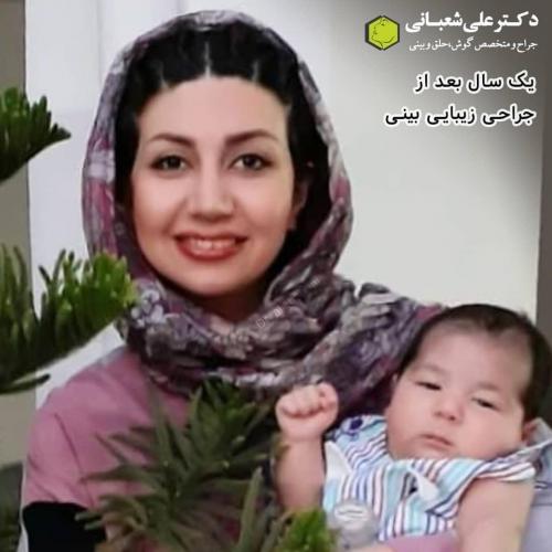 جراحی-بینی-در-بابل-172