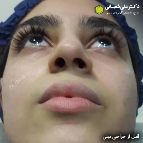 جراحی-بینی-در-بابل-173