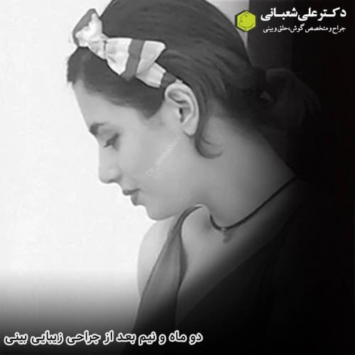 جراحی-بینی-در-بابل-174