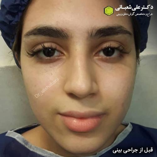 جراحی-بینی-در-بابل-175