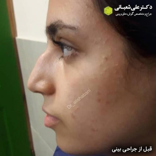 جراحی-بینی-در-بابل-177