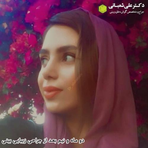 جراحی-بینی-در-بابل-178