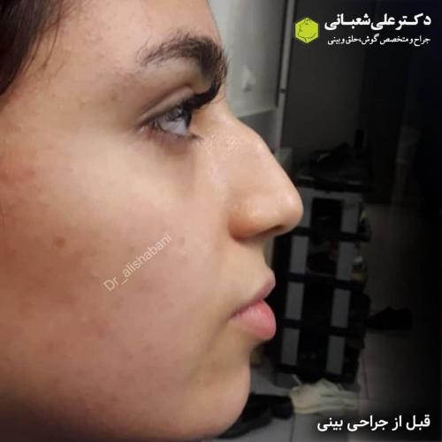 جراحی-بینی-در-بابل-179