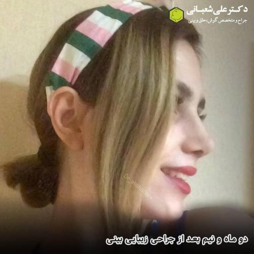 جراحی-بینی-در-بابل-180