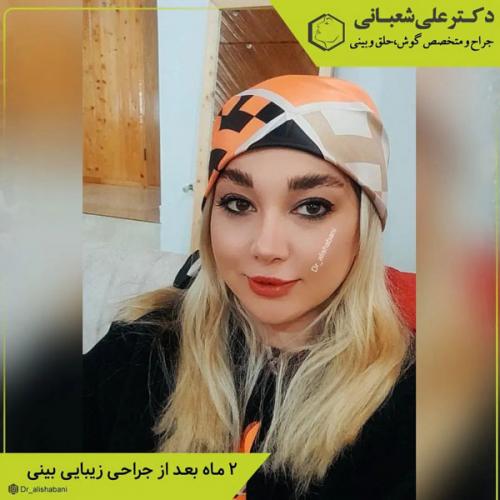 جراحی-بینی-در-بابل-401