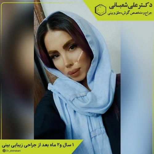 جراحی-بینی-در-بابل-402