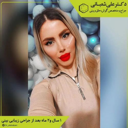 جراحی-بینی-در-بابل-403