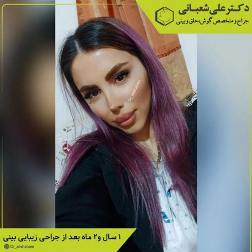 جراحی-بینی-در-بابل-404