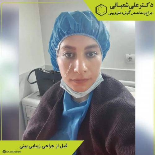 جراحی-بینی-در-بابل-405