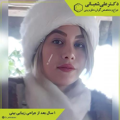جراحی-بینی-در-بابل-406