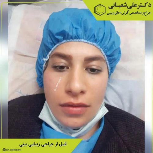 جراحی-بینی-در-بابل-407