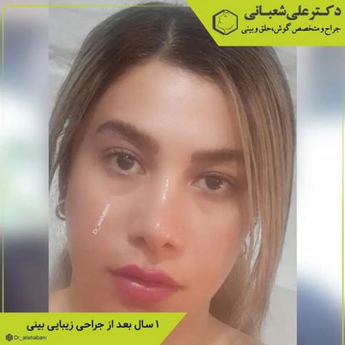 جراحی-بینی-در-بابل-408