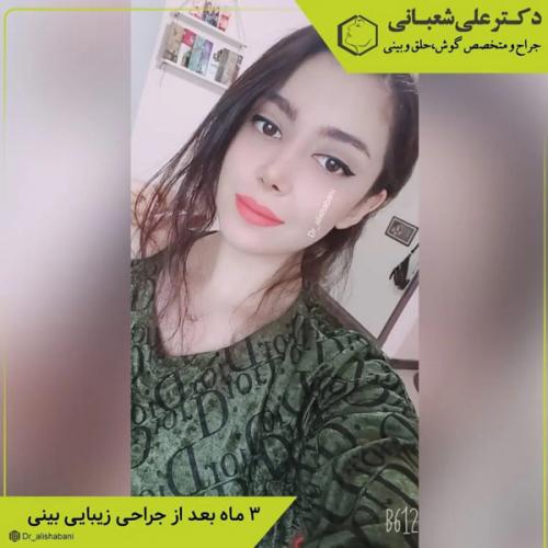 جراحی-بینی-در-بابل-409