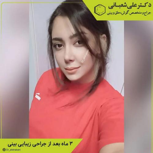 جراحی-بینی-در-بابل-410