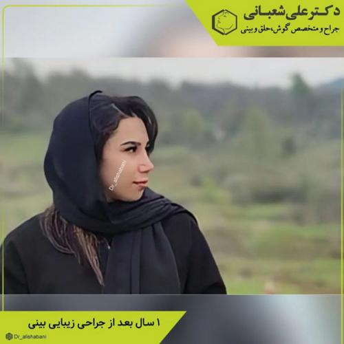 جراحی-بینی-در-بابل-411