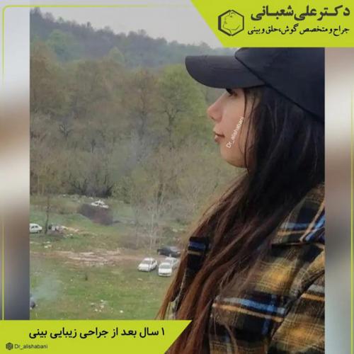جراحی-بینی-در-بابل-412