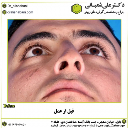 جراحی-بینی-در-بابل-414 (1)