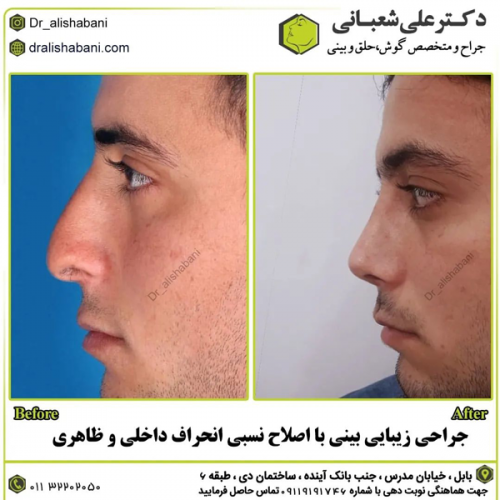 جراحی-بینی-در-بابل-415