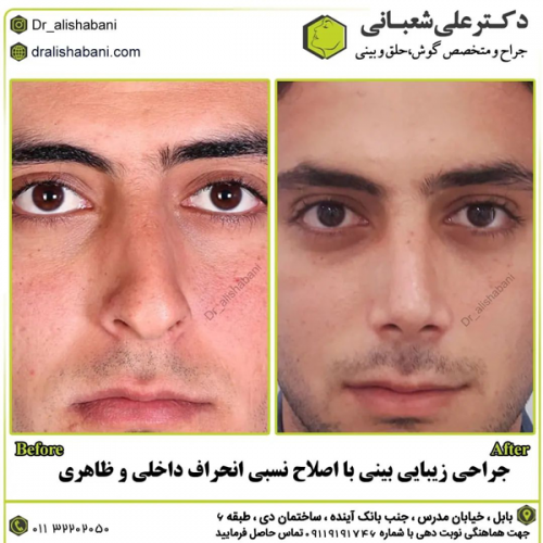 جراحی-بینی-در-بابل-416